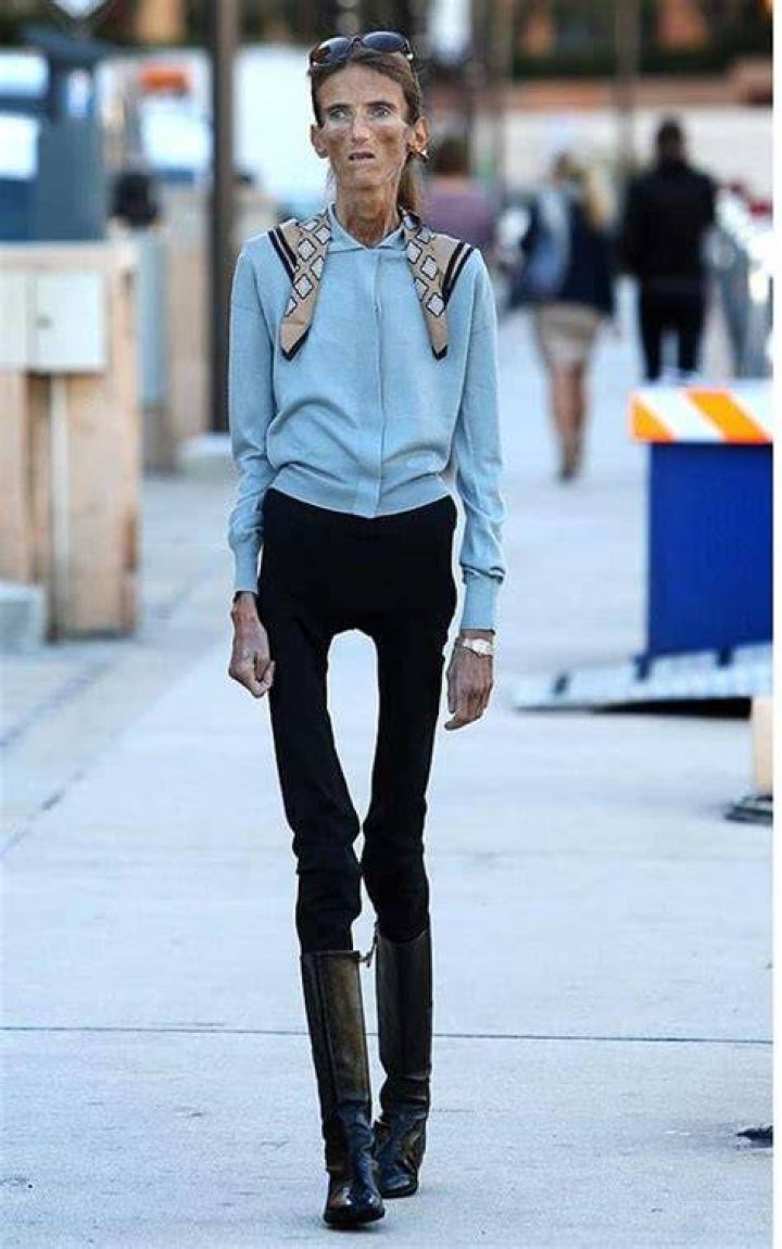 5 Skinniest People in the World