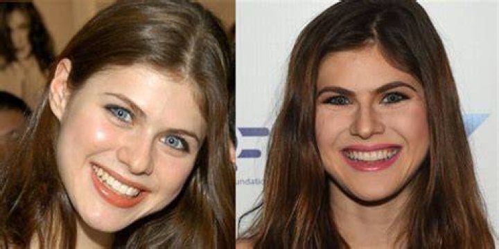 Did Alexandra Daddario Undergo a Breast Reduction?