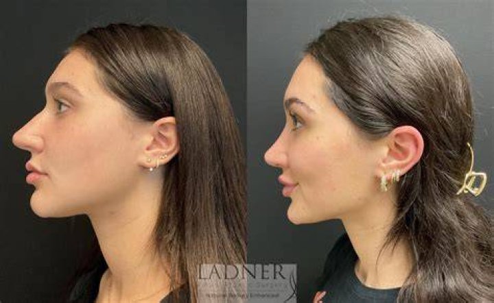 Did Aubrey Plaza Get Her Nose Done? Plastic Surgery Before And After Photos