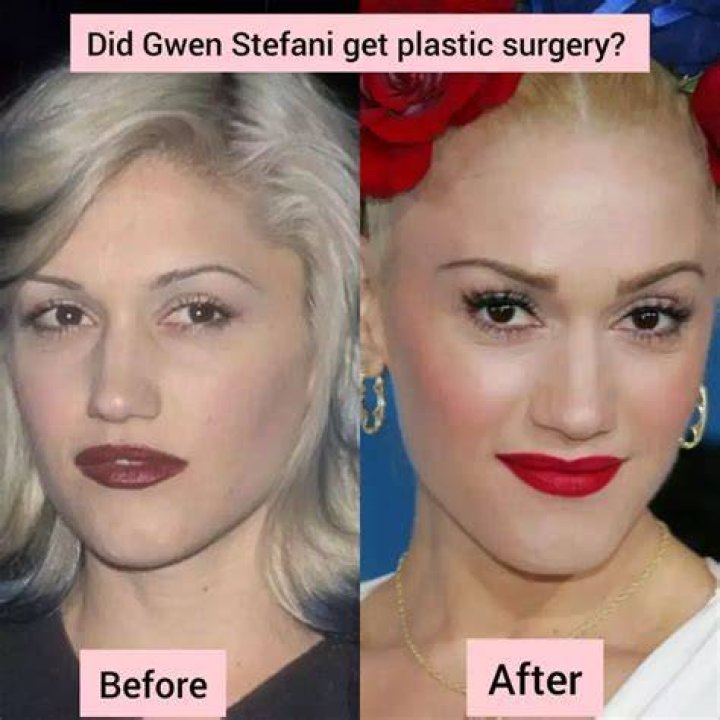 Did Gwen Stefani Undergo Plastic Surgery? Before and After Photos Explored