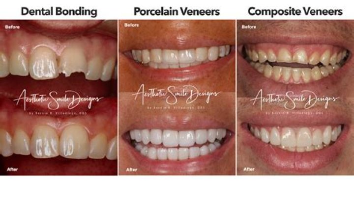 Does Freddie Freeman Have Fake Teeth or Veneers? Before and After Pictures