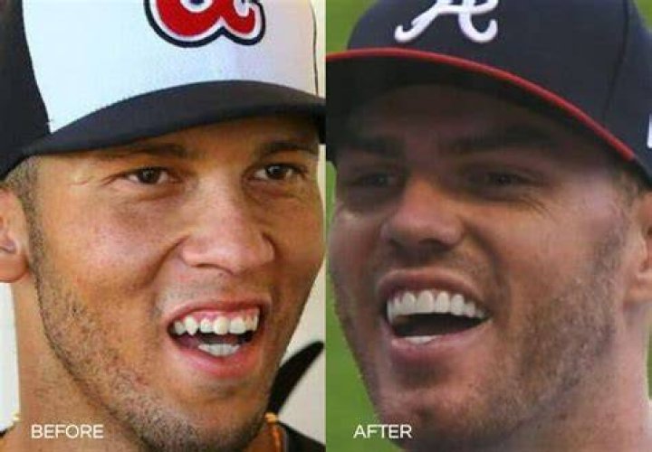 Does Freddie Freeman Have Veneers? Fake Teeth Rumors Of The American Baseball Player