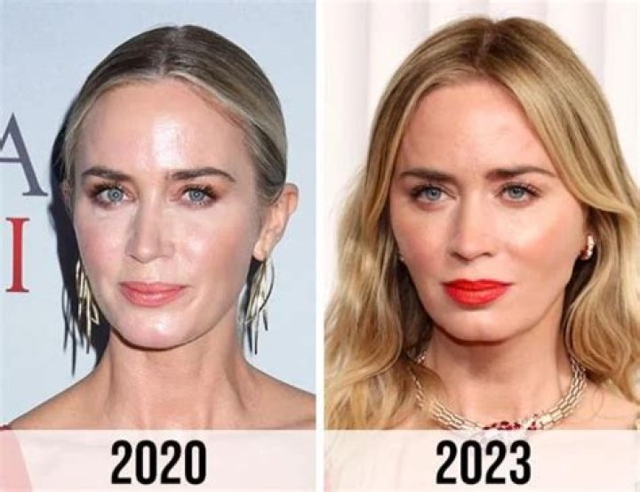Emily Blunt Plastic Surgery: Did She Get Botox and Fillers on Her Face?