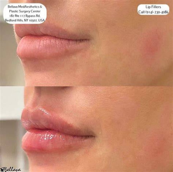 Has Gemma Owen Done Plastic Surgery? Fans Suspect 19-Year-Old Has Lip Filler
