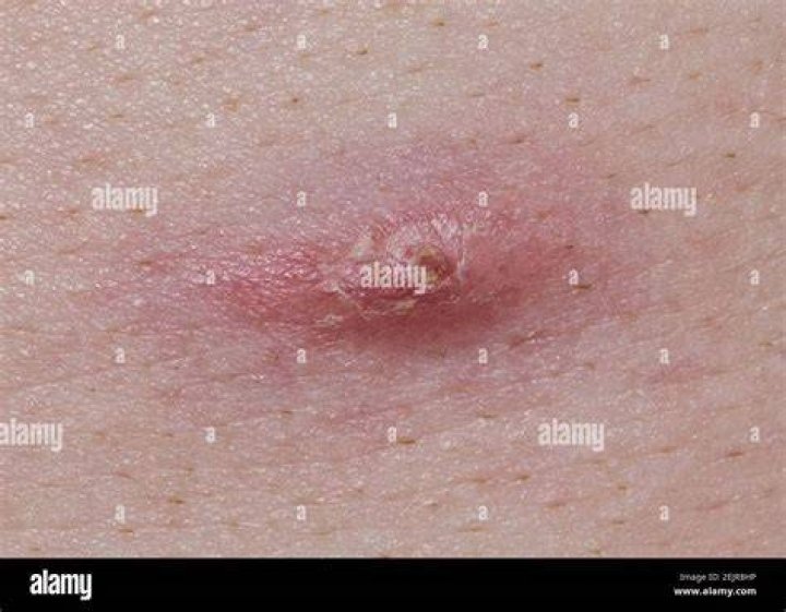 How to get rid of pimple scabs