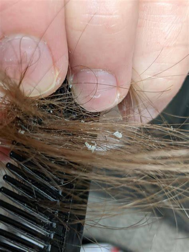 How to get rid of white piedra