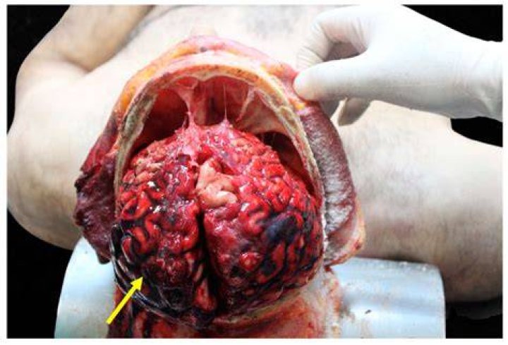 Patrick Torrey Dementia And Illness: Autopsy Report And Health Update 2023