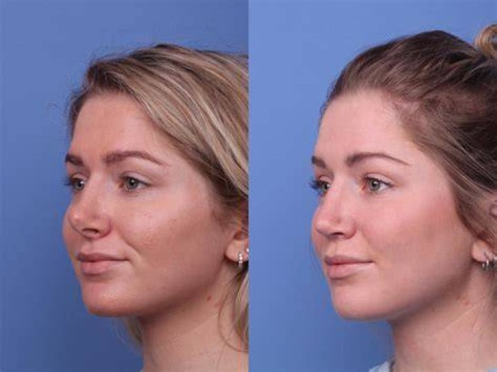 Perfect Match: Did Francesca Farago Get Her Lips Done? Plastic Surgery Before And After