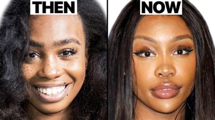 Skai Jackson Surgery Update: What Happened To Her Nose?
