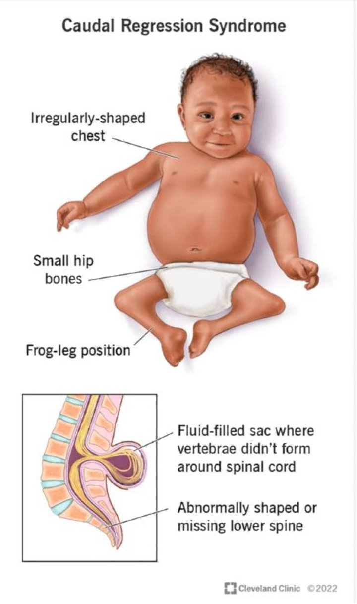 What Happened To Zion Clark? Story About His Caudal Regression Syndrome Disease