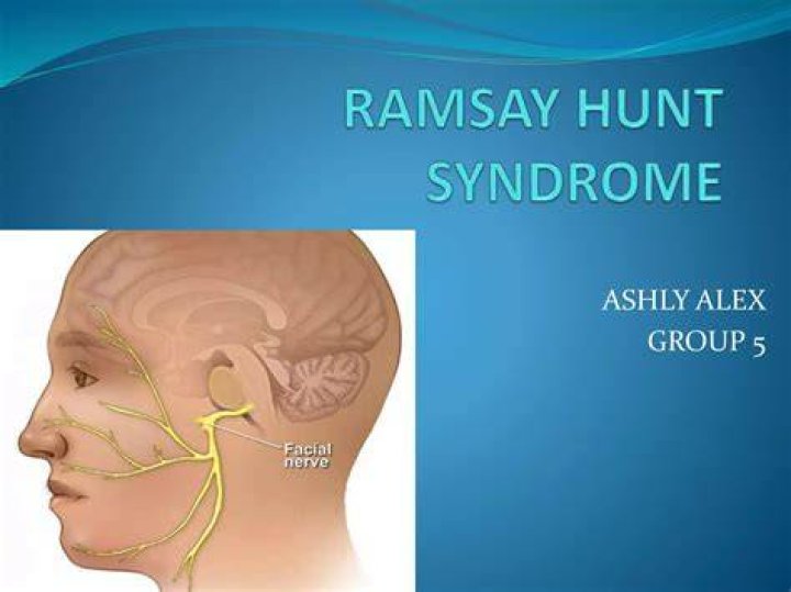 What Illness Does Tony Horton Has? Health Update, Ramsay Hunt Syndrome Explained