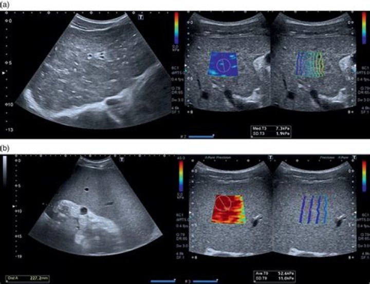 What is altered parenchymal echotexture